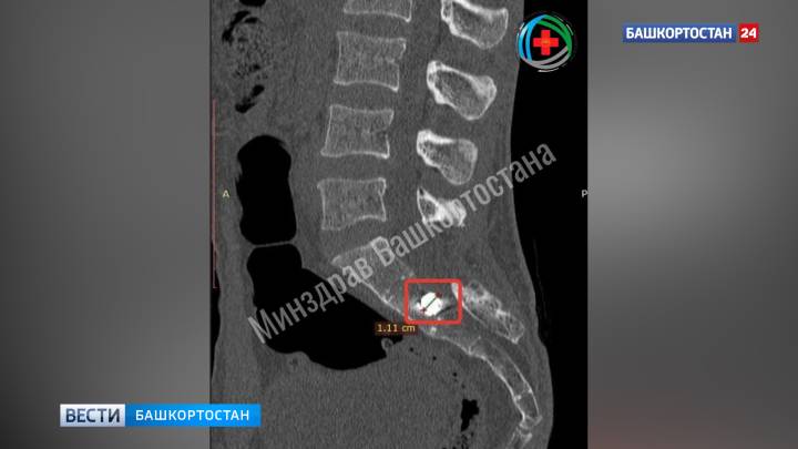 В Башкортостане хирурги спасли бойца СВО с осколком снаряда в позвоночнике | ГТРК «Башкортостан»