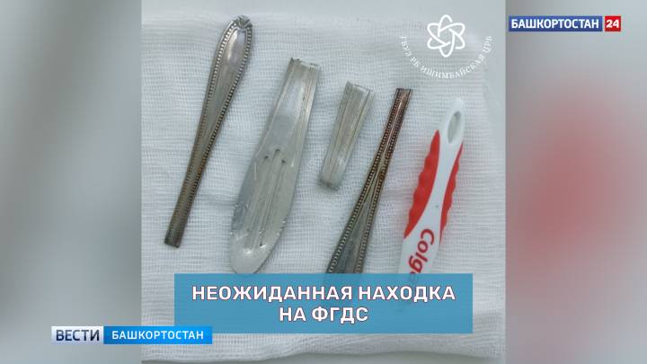 Ложки, вилки и зубную щетку достали из желудка пациента врачи в Башкортостане | ГТРК «Башкортостан»